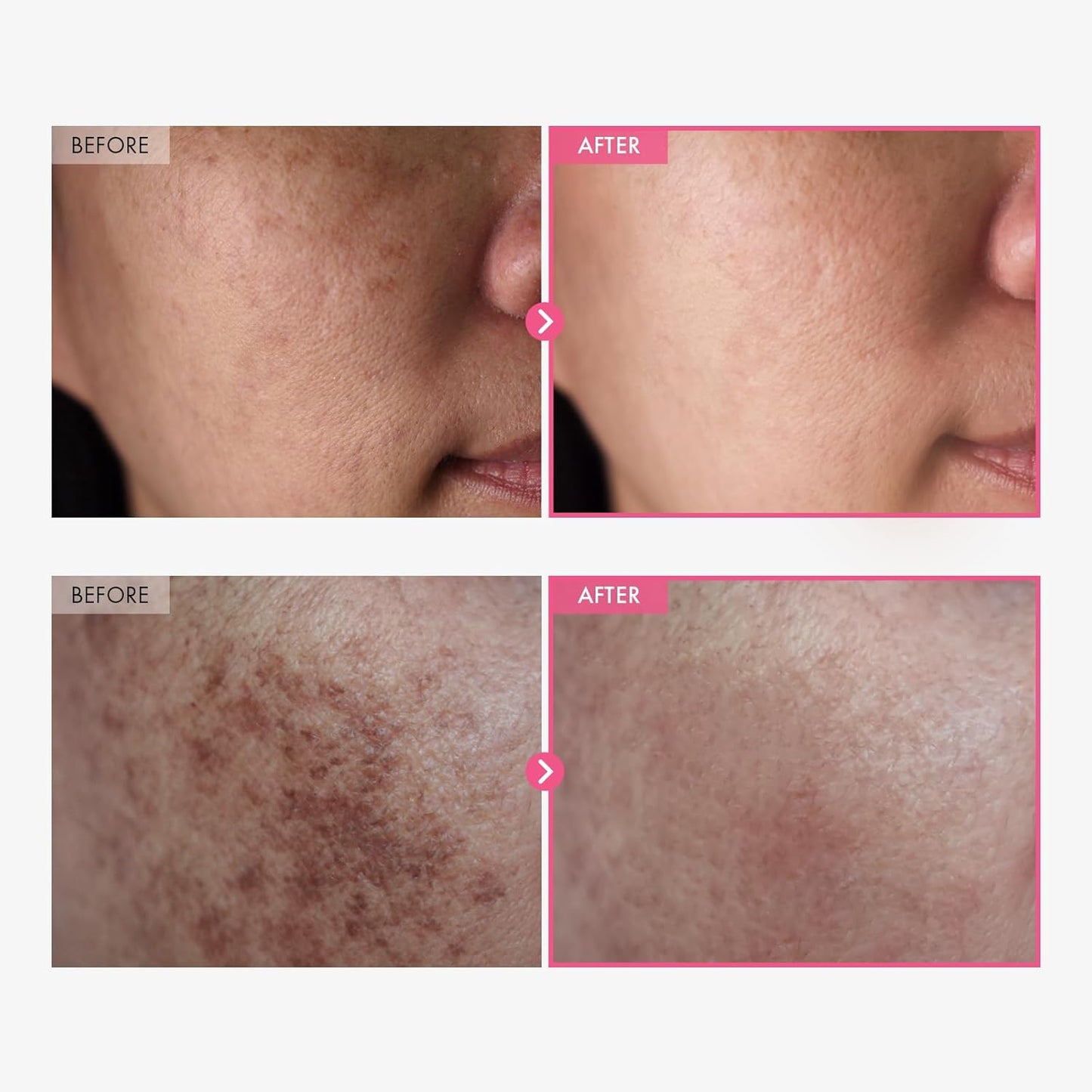 Arbutin 7% + Tranexamic Acid 4% Brightening Cream – 50ml